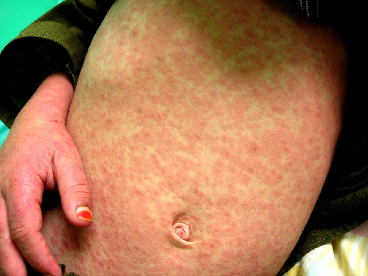 Three Unvaccinated Kids Who Traveled Through DIA Test Positive for Measles