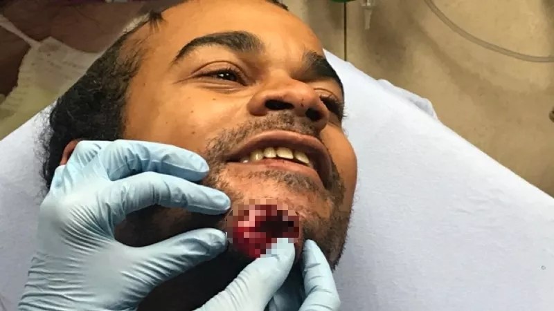 Denver Pushes Back Against Protester Suing Over His Chin Being Blown Off