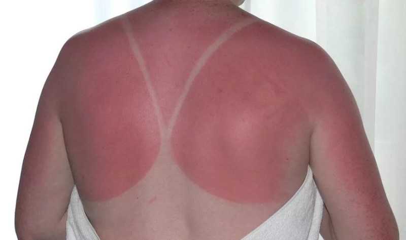 A woman's back with a sunburn